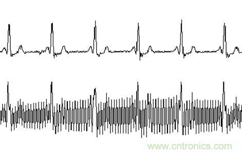 采用MSP430設(shè)計的12位心電(ECG)放大器